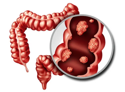 Colon and Rectal Cancer (Colorectal Cancer - CRC) consultation at Niraaya Hospital